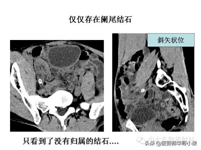 阑尾炎课件,阑尾炎的超声课件