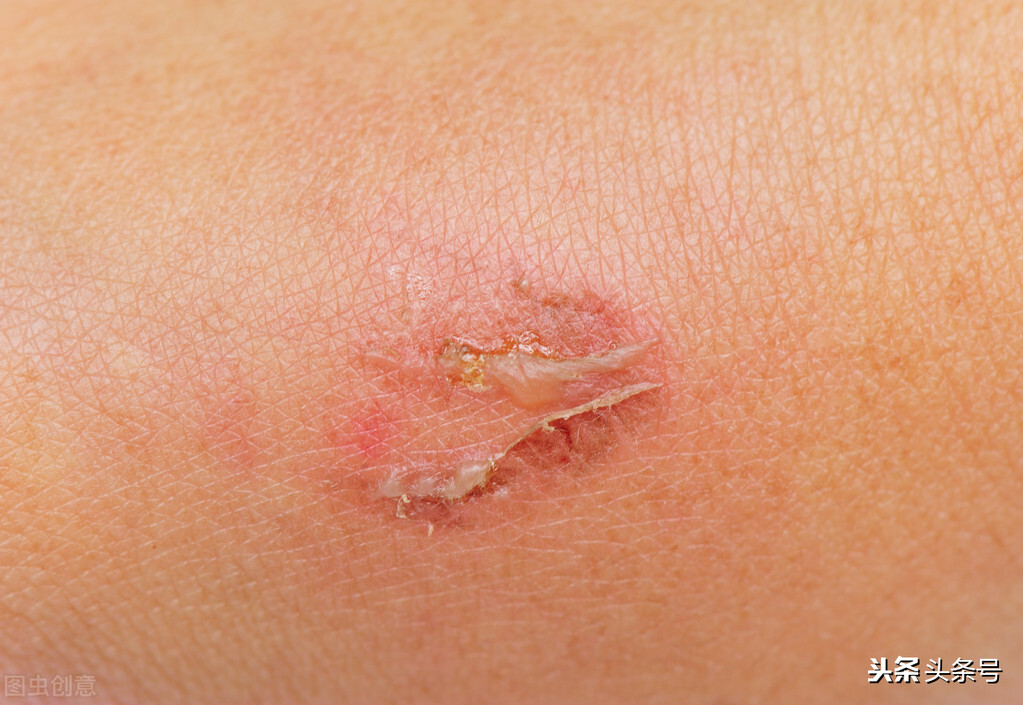 疤痕发红是什么原因呢,疤痕发红是什么原因引起的