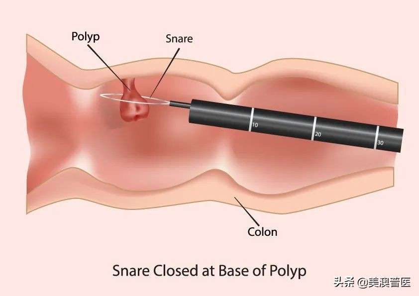 关于肠息肉切除，这些事情你一定要知道！