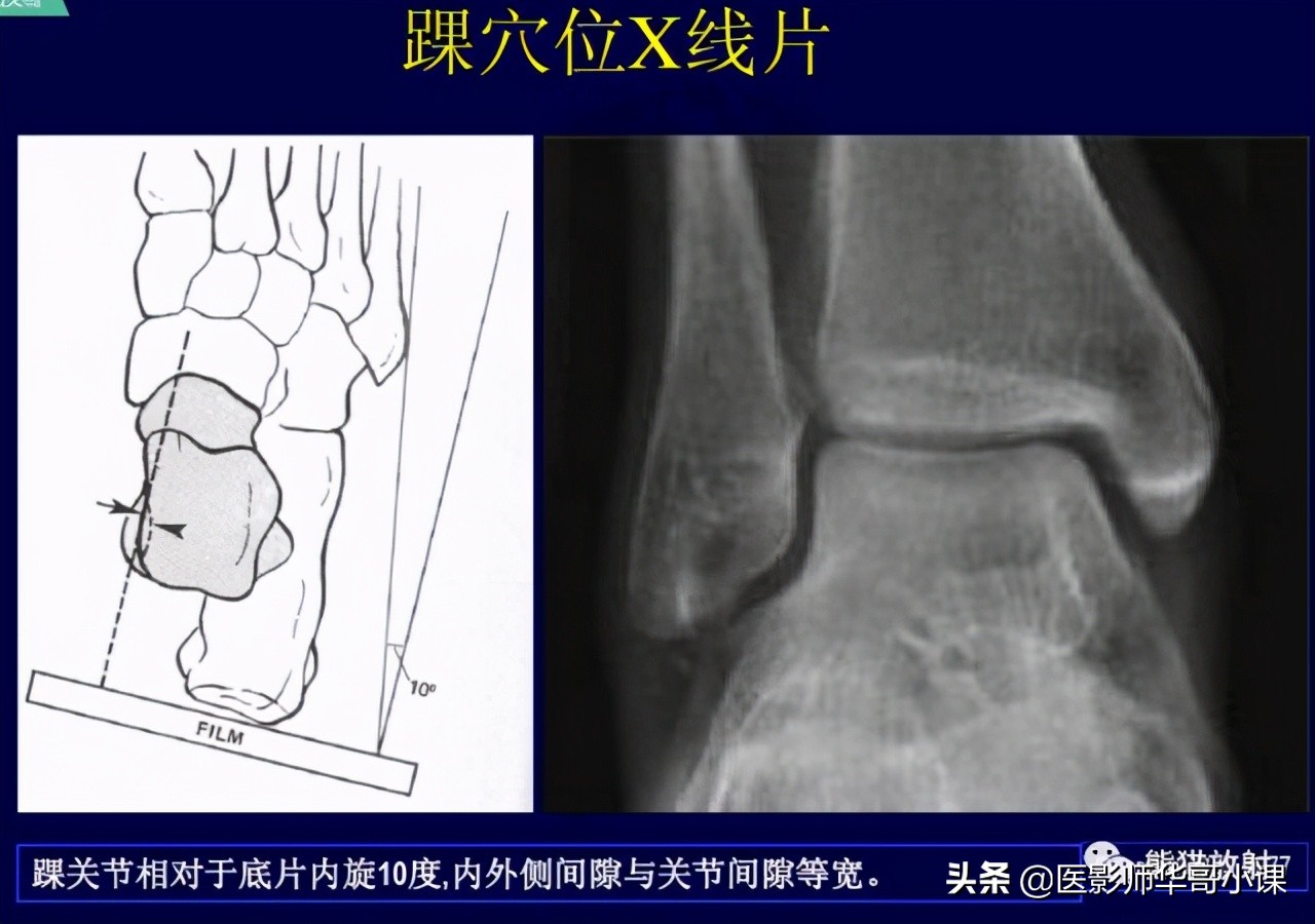 踝关节解剖视频课,解剖学韧带分布图