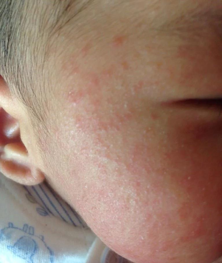 月嫂面试湿疹怎么处理,月嫂一走就长湿疹