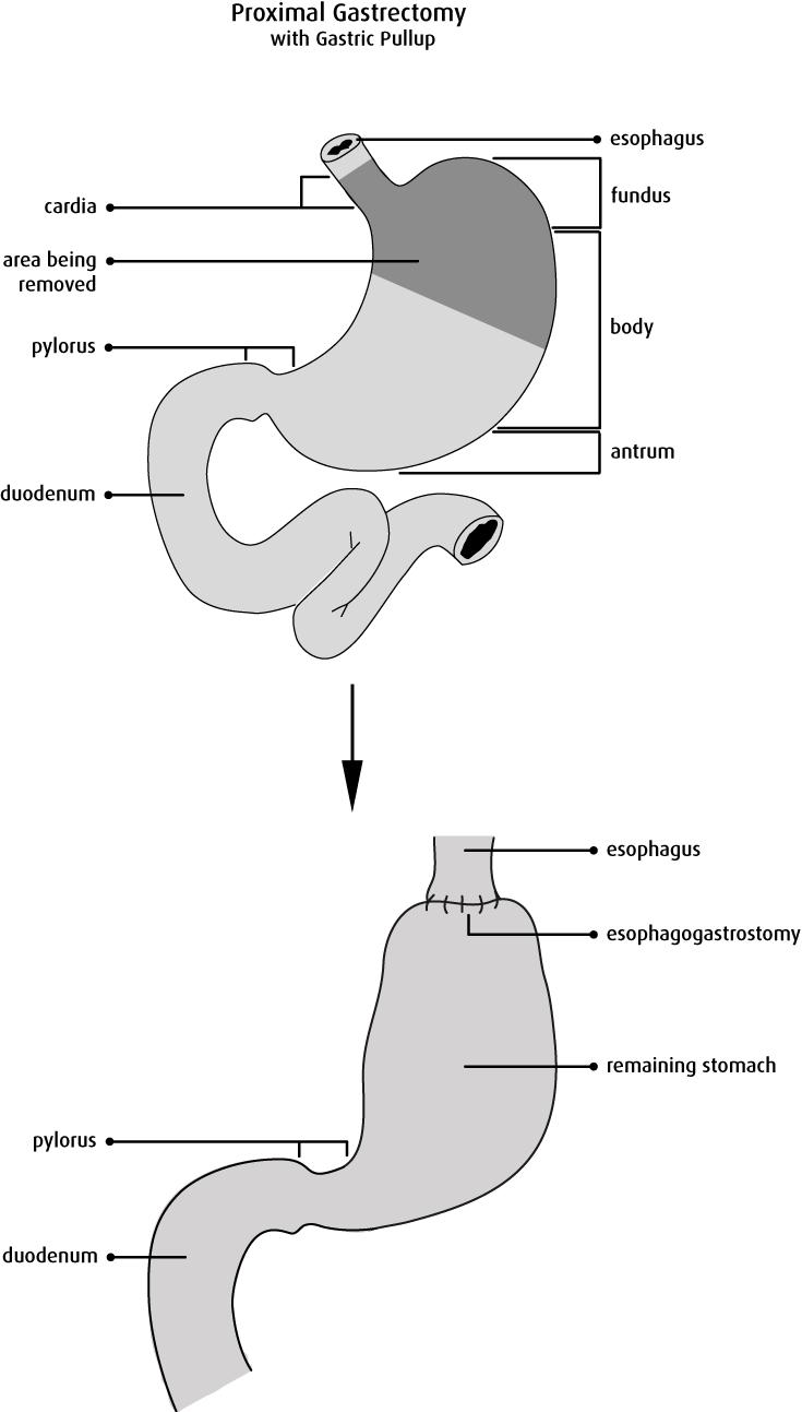 胃萎缩性糜烂胃炎能痊愈吗,萎缩性胃炎胃溃疡中药能治好吗