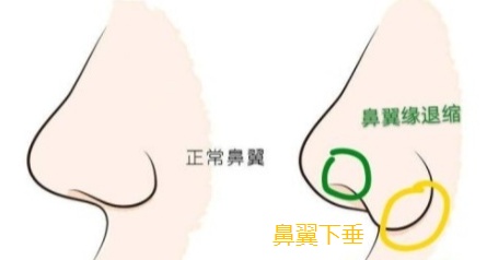 30岁怎么解决鼻翼两边下垂,鼻翼下垂但是中庭长怎么整容