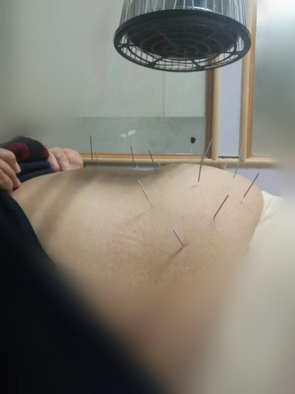针灸减肥一个月15斤,第一次针灸减肥