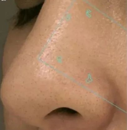 顽固黑头怎么去除最有效,祛除黑头最有效的方法