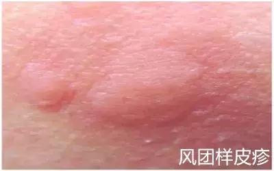 6种儿童常见皮肤病的鉴别指导,孩子容易出现的皮肤病你了解多少