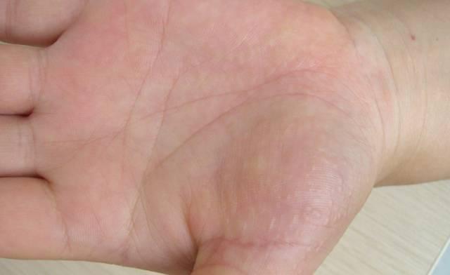 如何分辨湿疹还是汗疱疹,手癣湿疹汗疱疹怎么区分