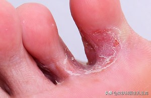 医院皮肤科医生治脚气用什么药,皮肤科医生脚气脚臭怎么办