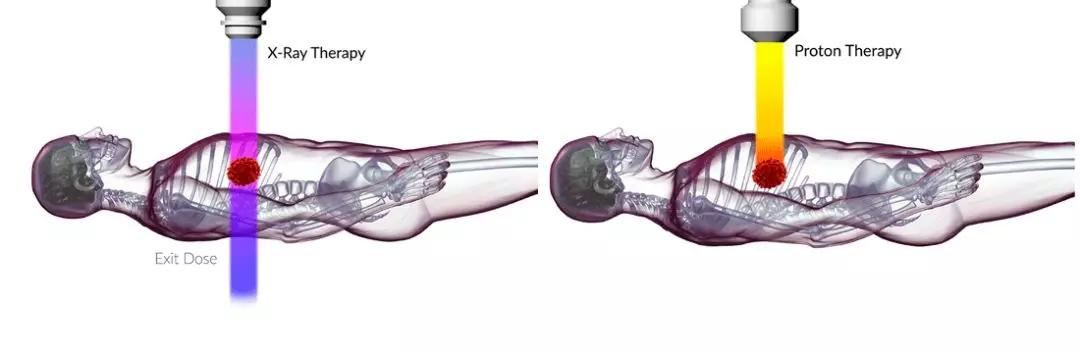 质子治癌细胞靠谱吗,质子治疗能彻底治愈癌症吗