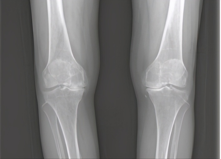 不同部位膝关节,骨科医生教你一招搞定膝盖痛