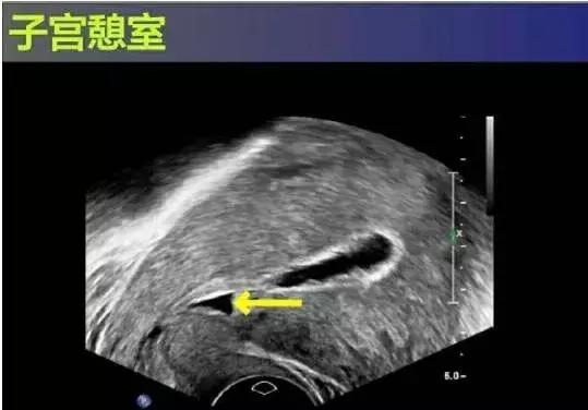 子宫憩室手术后怎么调理身体,子宫憩室手术后还会有憩室吗