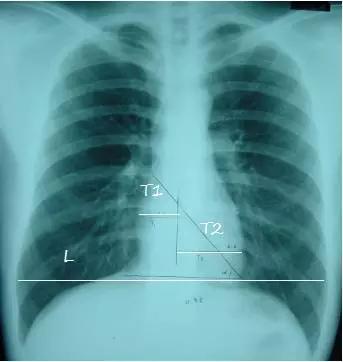 拿到胸部ct我们该怎么看,怎样看懂胸片报告单