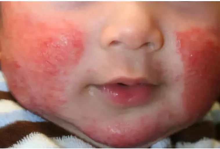 普及!宝宝湿疹不敢用药怕激素?湿疹护理指南来帮你