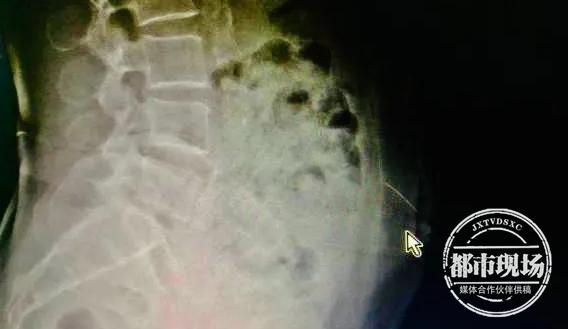 针灸毫针断体内不取出来有事吗,针灸断针取出术