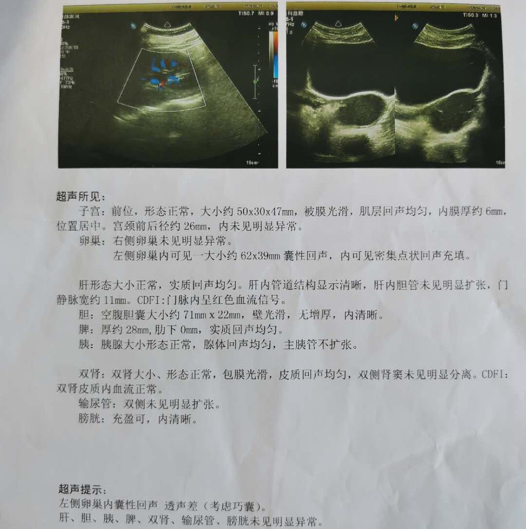 一根针抽吸“囊液”，微创治疗囊肿的方法一起了解一下