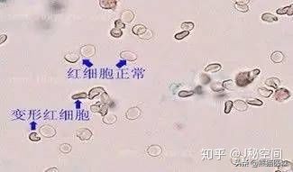 尿常规出现红细胞是胃出血吗,尿常规出现红细胞原因