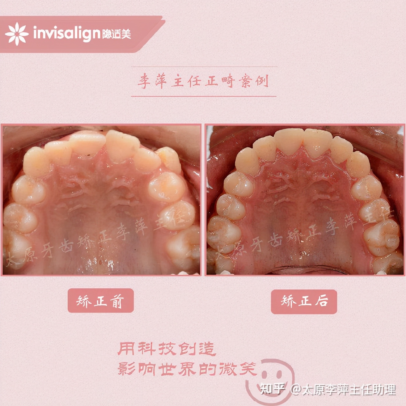 重度拥挤矫正牙齿适合隐形牙套吗,广州成人牙齿矫正推荐隐形牙套