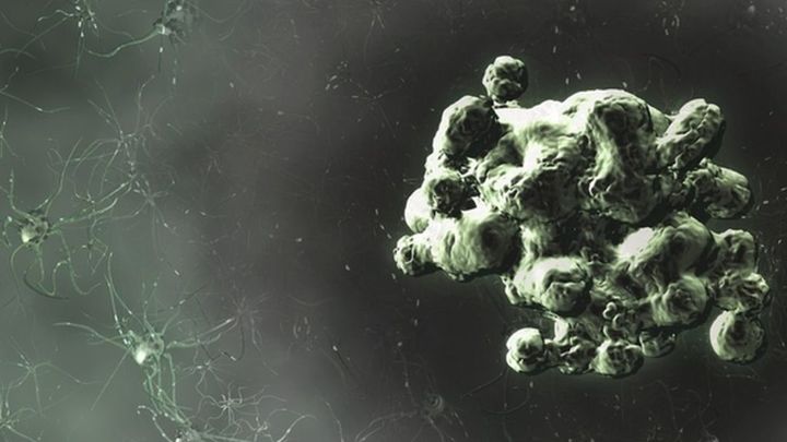 致死率百分百疾病,感染朊病毒有多可怕