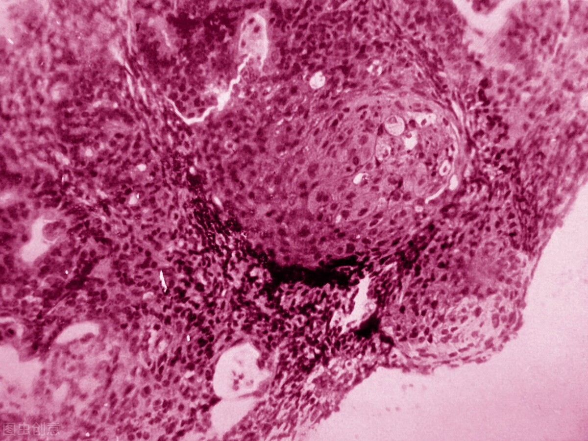 子宫内膜癌出血多久才能判断是癌,子宫内膜癌阴道出血症状