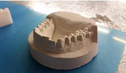 牙科隐形矫正器牙套制作,制作矫正牙套全过程