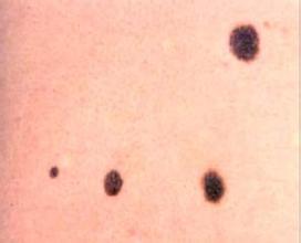 色素痣的首选治疗方式,激光治疗色素痣需要多少钱