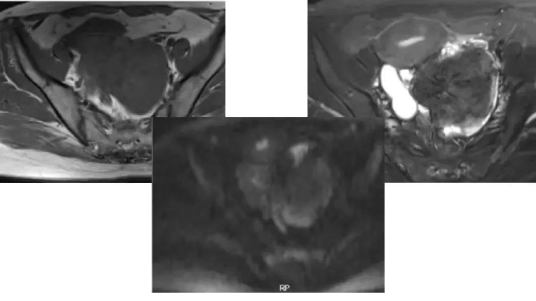 卵巢原发肿瘤的分析思路