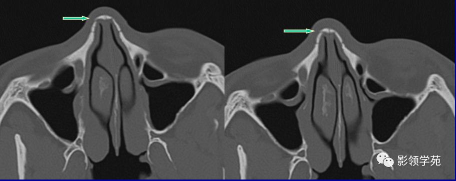 鼻骨骨折的检查方法,鼻骨骨折影像学表现