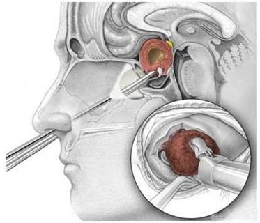 釜底抽薪的方剂,釜底抽薪治法