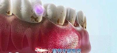 牙黄口臭一招搞定,美白牙齿最有效的方法洗牙