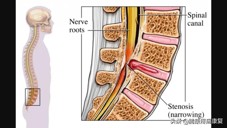椎管狭窄走路腿疼怎么回事,腰椎管狭窄引起的腿疼
