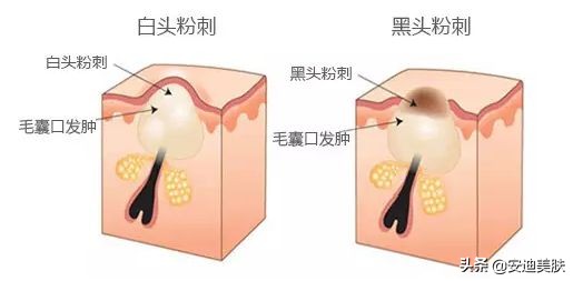 鼻子上有黑头粉刺怎么去除不花钱,鼻子螨虫黑头怎么去除简单方法