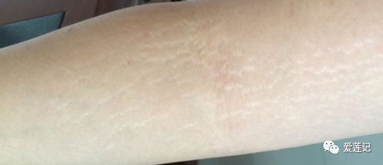 肥胖纹和皮疹的区别,肥胖纹和橘皮纹的区别