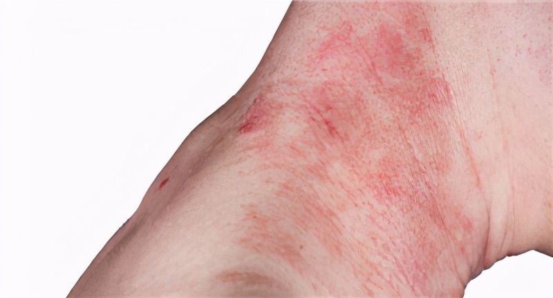 挠痒快速止痒妙招,夏季过敏性皮炎痒了能挠吗