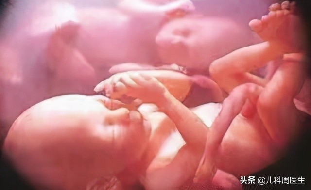 胎儿脐带绕颈怎么绕出来,胎儿脐带绕颈2圈