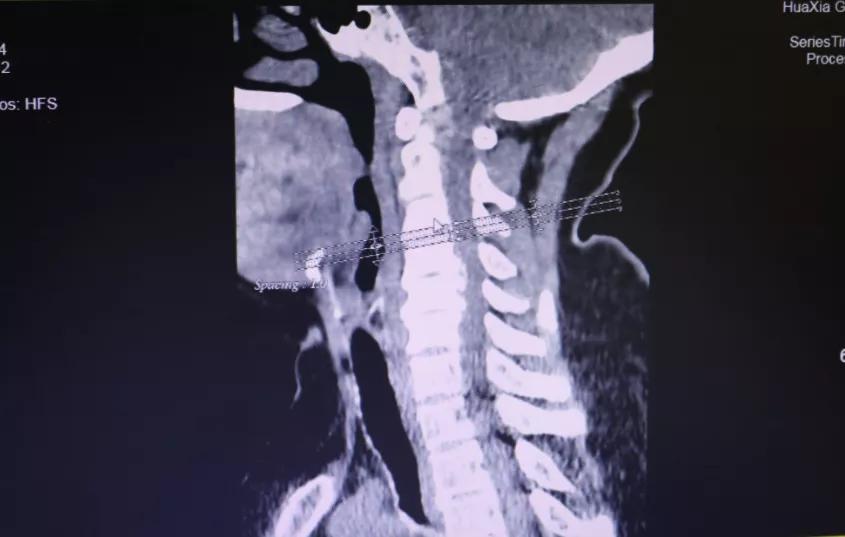颈椎病手麻手痛怎么治疗,颈椎病手麻无力怎么锻炼