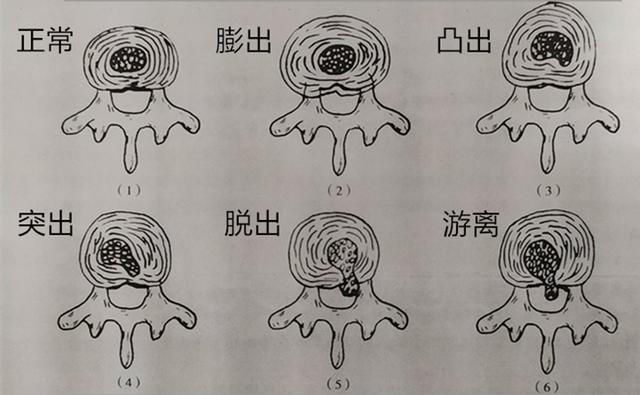 腰椎间盘突出什么方法好得快,腰椎间盘突出用什么方法好得最快