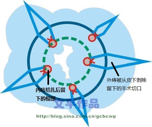 痔疮该怎么治疗？肛肠科朱医生答疑系列之二