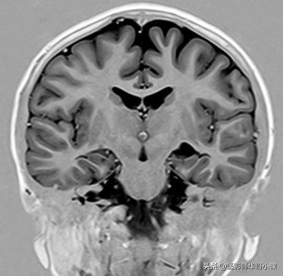 磁共振mri序列参数解读,磁共振mrcp用哪些序列