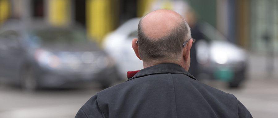 男性脂溢性脱发可以用生姜擦吗,脱发秃头用什么擦好
