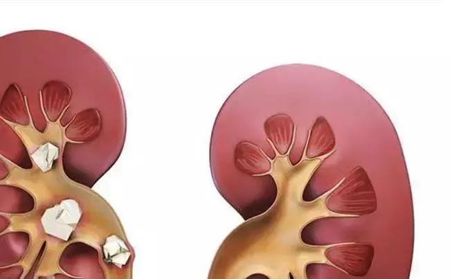 中医黄清春教授,黄清春治痛风方法