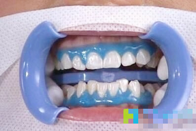 皓齿和冷光美白牙齿哪个好,效果好的牙齿冷光美白成功案例