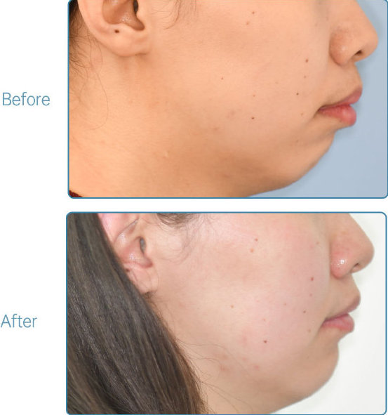 杭州牙齿矫正的全过程,杭州牙齿矫正哪个医生最好