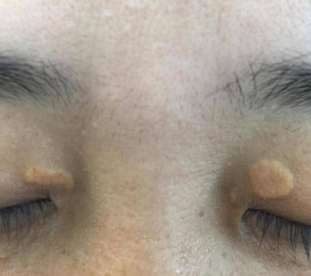 眼皮上有小疙瘩和心脏病有关系吗,心脏有问题眼皮会长什么