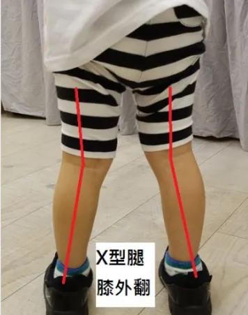 儿童足部常见问题,儿童足部运动康复训练动作大全