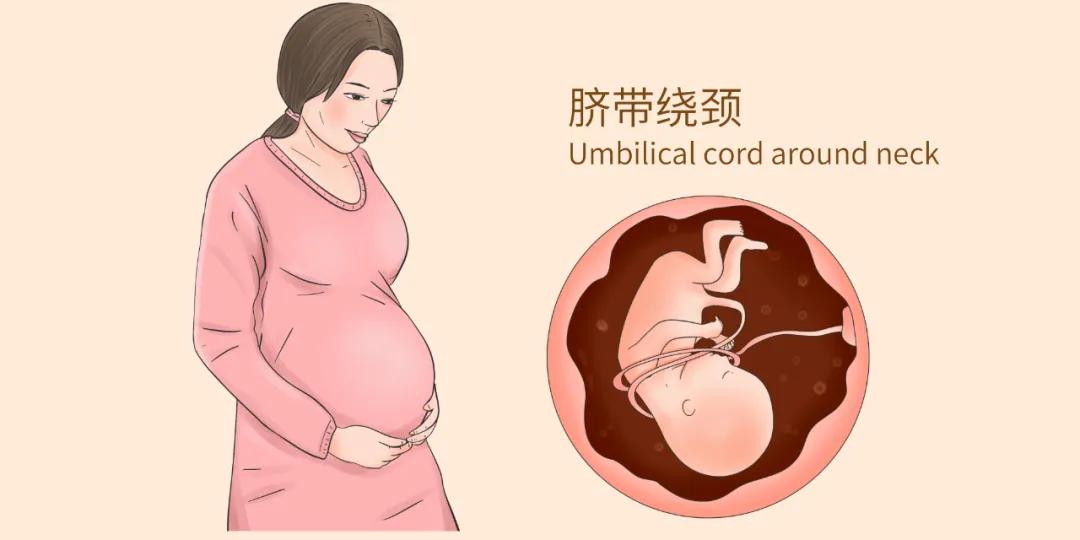 孕妈们胎儿脐带绕颈不要慌,脐带绕颈一般发生在多少周