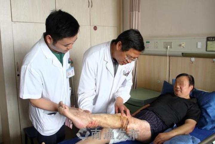 市三院精湛医术让烧伤老人重获新生