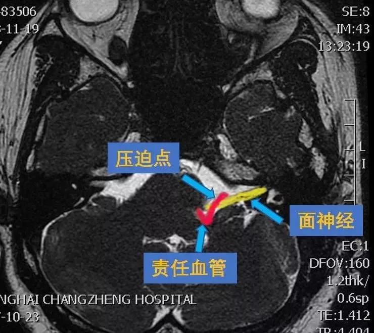 面肌痉挛偏方大全,面肌痉挛健康科普短视频