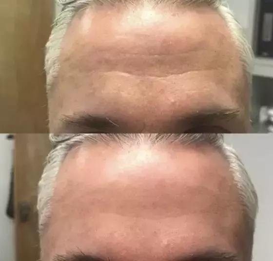 护肤黑科技顶级医美,用黑科技去除眼袋肿了十天