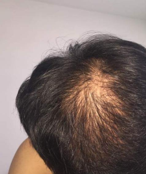 植发后怎么能让头发长得快,植发后怎么护理增加存活率