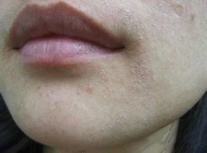 为啥要去脸部角质,为什么要去皮肤上的角质